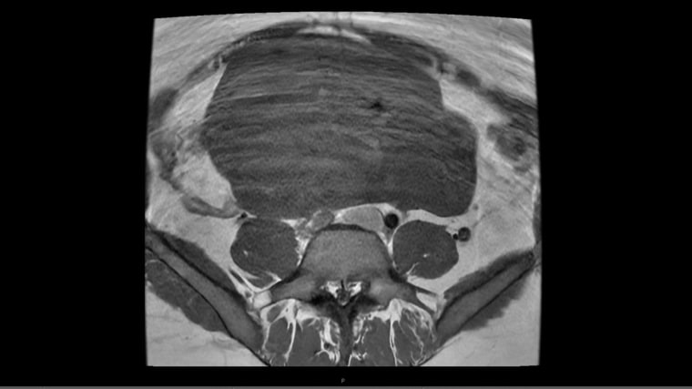 El fibroma de Natalie Suflita había ocupado gran parte de su abdomen y tenía aproximadamente el tamaño de una sandía.