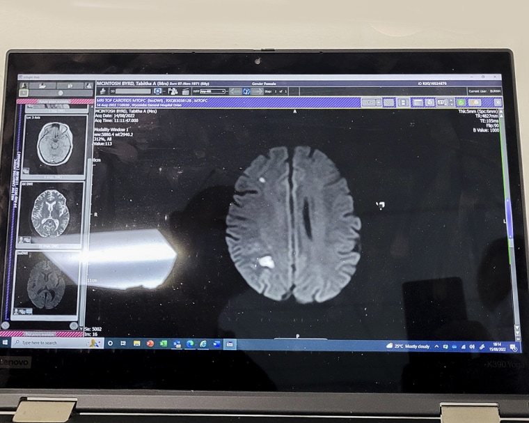 A scan of Tabitha McIntosh's brain after she thought perimenopause caused her constant headache, but it was a sign of a stroke.