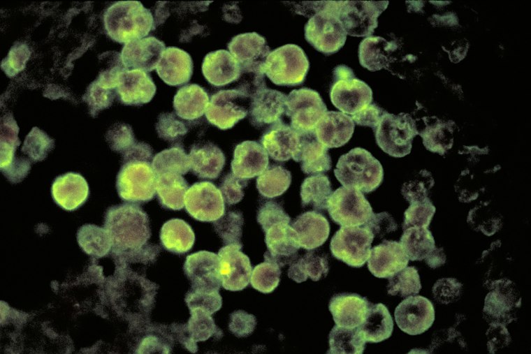 Child’s death in Nebraska may have been from brain-eating amoeba, officials say