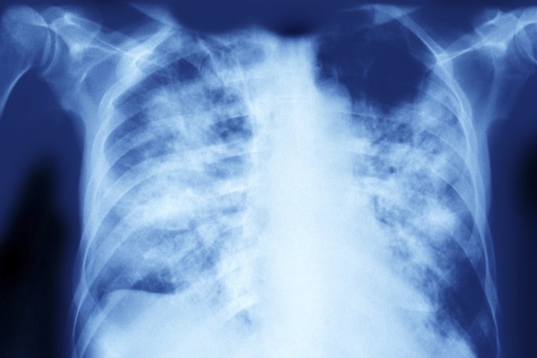 An X-ray image showing pulmonary aspergillosis. 