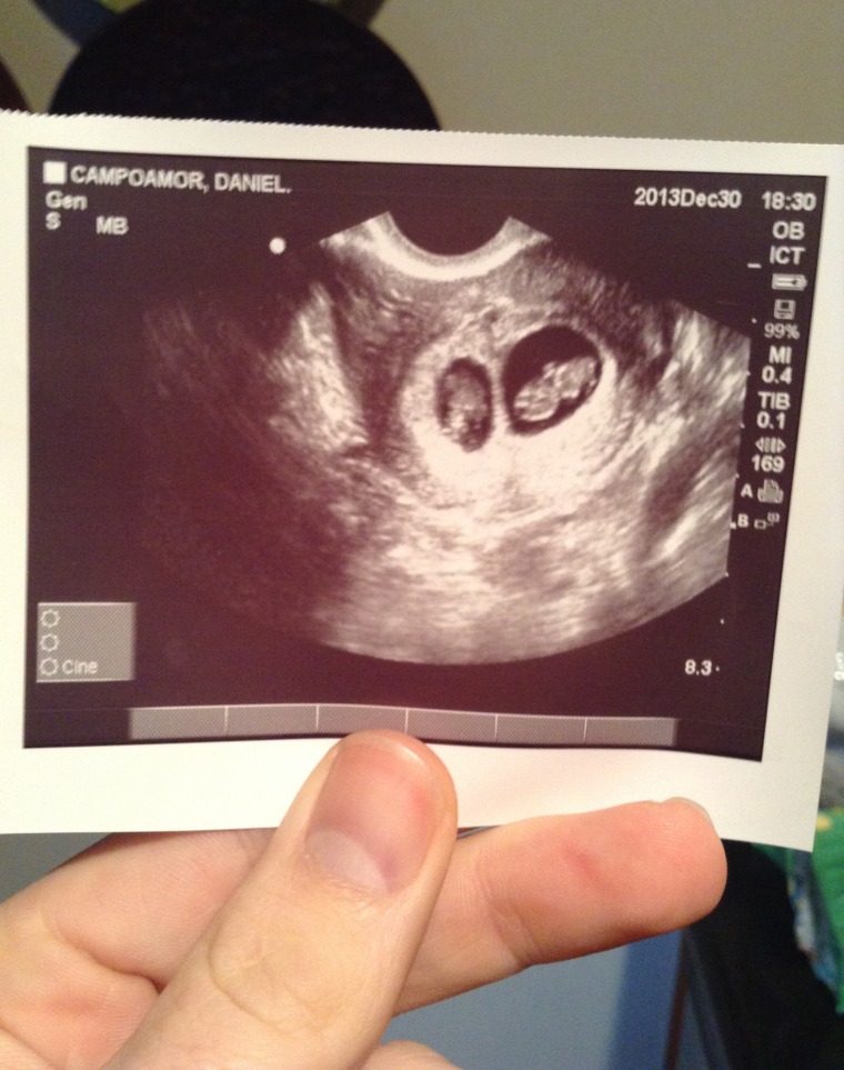 The first ultrasound and confirmation of the author's twin pregnancy.