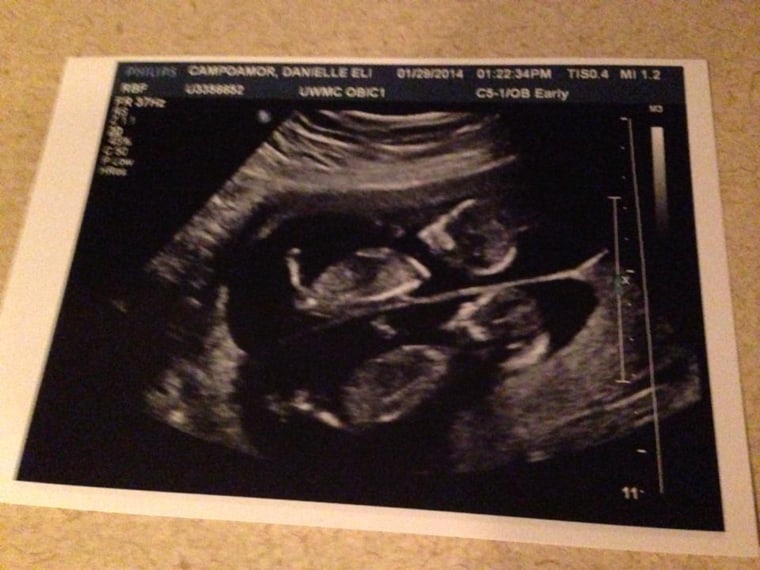 The last ultrasound picture of Twin A and Twin B.