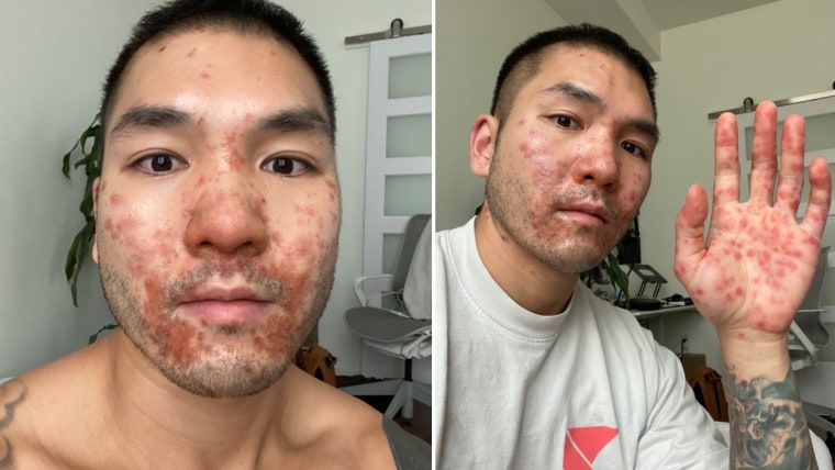 Kevin Kwong recibió varios diagnósticos equivocados, como herpes y sarna, porque sus lesiones no lucían como las de las fotos que los médicos habían visto de la viruela de mono.