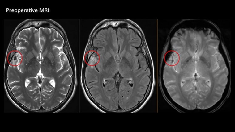 Preoperative MRI.