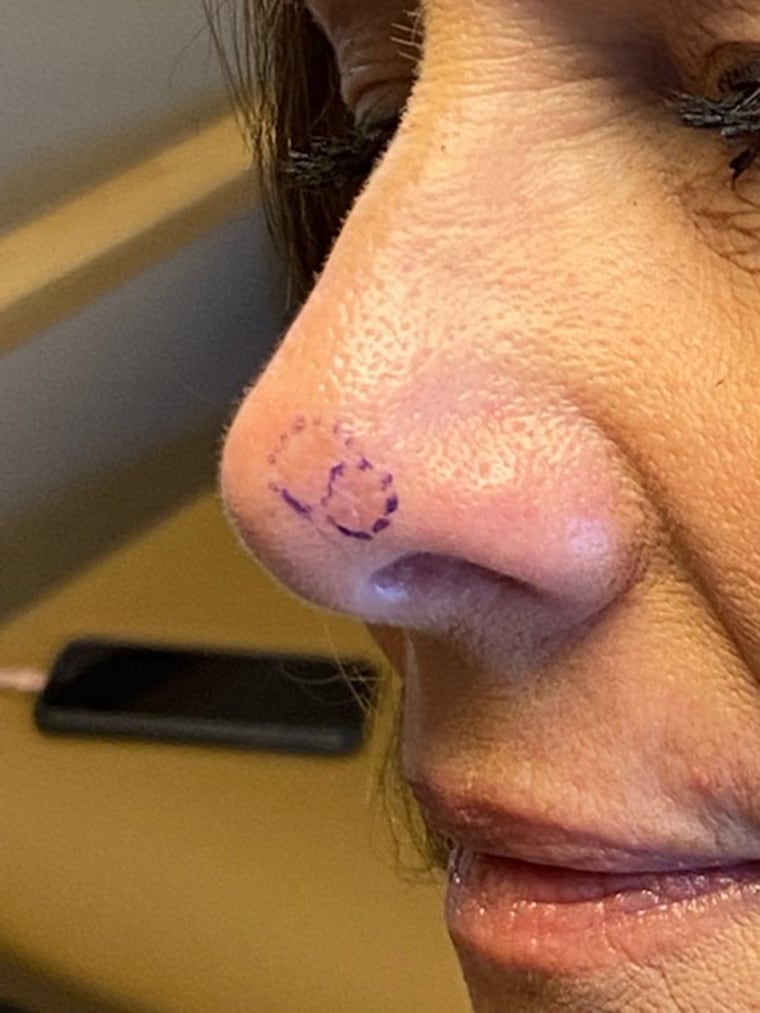 This photo shows the suspicious spot on Sabine's nose before surgery.