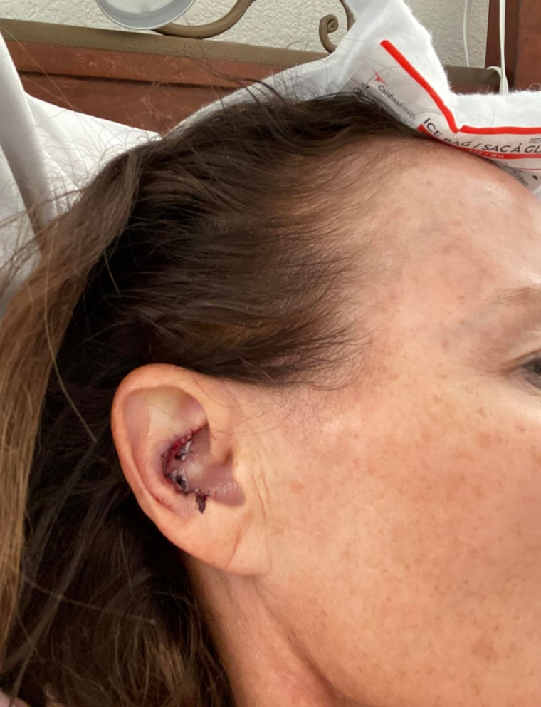 "The ear was the most painful of all," Sabine said. "They had to bolt it together."