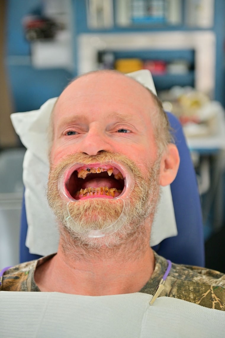 Mike "Sugar Bear" Thompson gets a complete dental makeover.