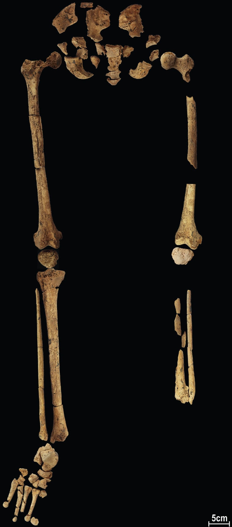 one-legged-stone-age-skeleton-may-show-oldest-amputation