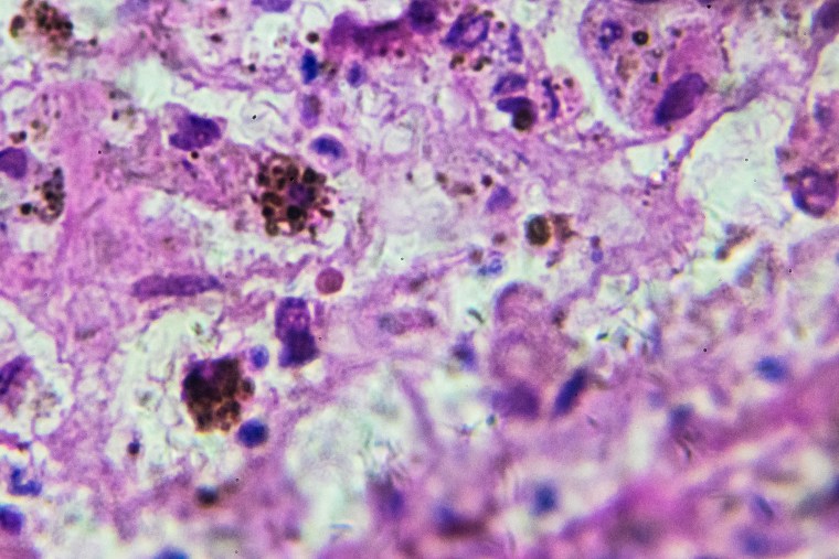 Melanoma biopsy under microscopy