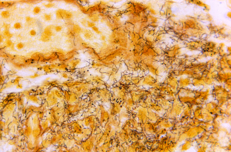 A tissue sample with the presence of numerous, corkscrew-shaped, darkly-stained, Treponema pallidum spirochetes, the bacterium responsible for causing syphilis.