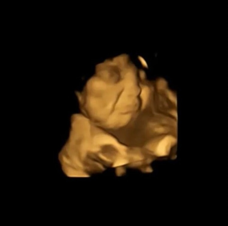 Una imagen del estudio FETAP (Fetal Taste Preferences) que muestra la reacción de una mueca al sabor de la col rizada.