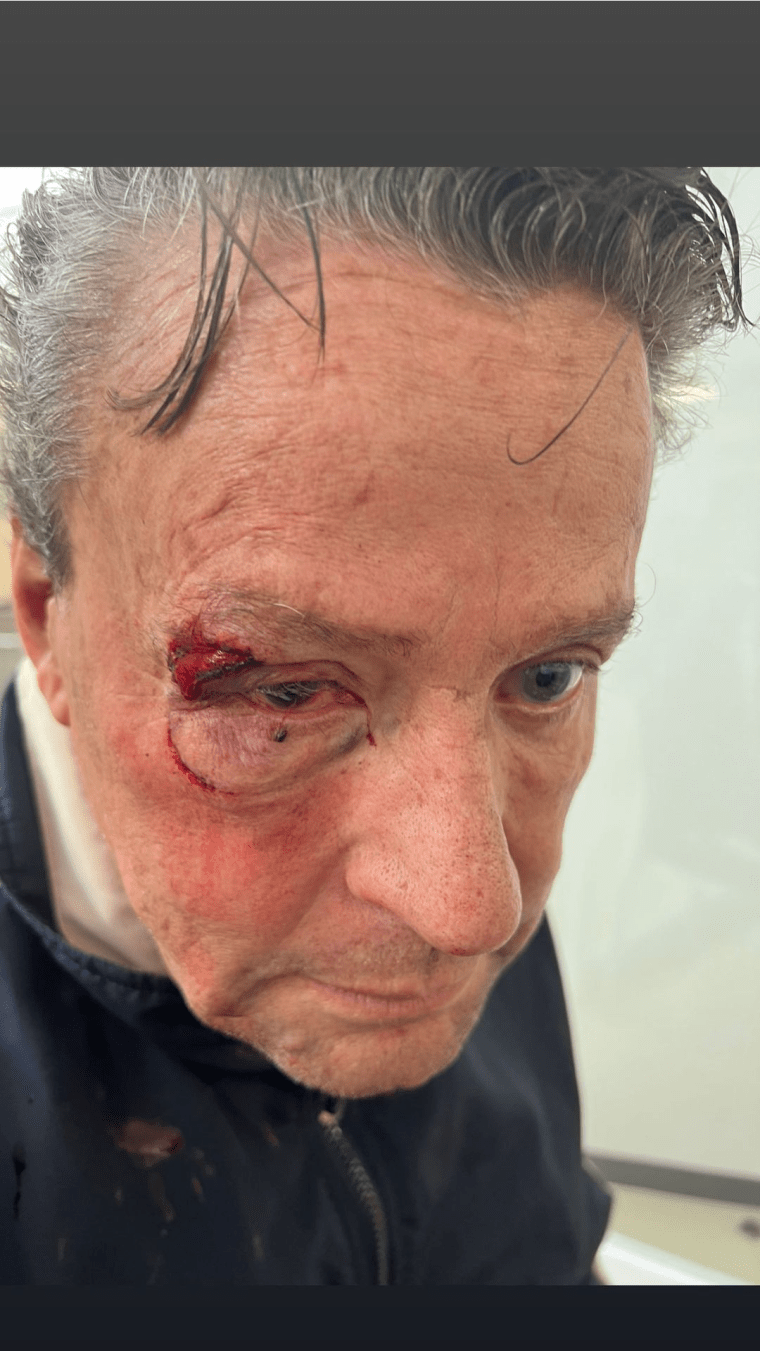 Alfredo Adame es golpeado en uno de sus ojos.