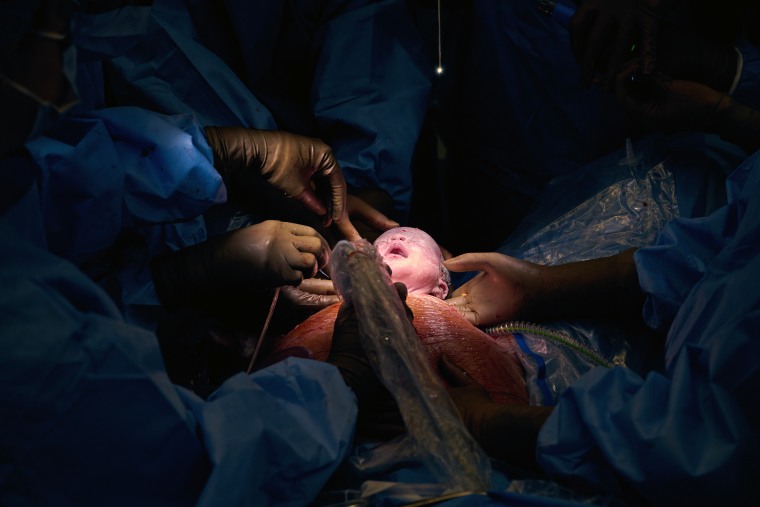 Dozens of medical professionals participated in the EXIT procedure, where Dr. Ashley Roman delivered baby Aydin's head, neck and shoulders so Dr. Scott Rickert could perform a tracheotomy so Aydin could breathe without mom's help.