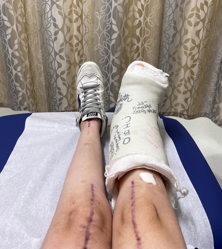 Meghan Bradshaw has had the joints in her lower extremities completely replaced. A late diagnosis of Lyme arthritis plus a connective tissue disorder likely contributed to the severity of her joint deterioration and the need for so many joint replacements before turning 30.