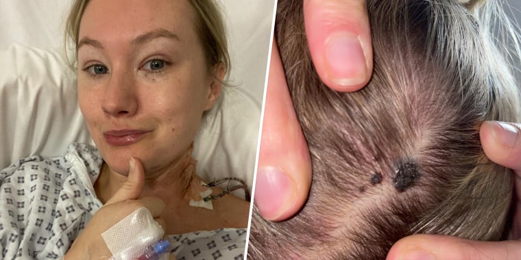 Sarah Lee underwent an eight-hour surgery to remove 24 lymph nodes from her neck after the mole on her scalp turned out to be melanoma. The first doctors she saw told her the spot was nothing to worry about.