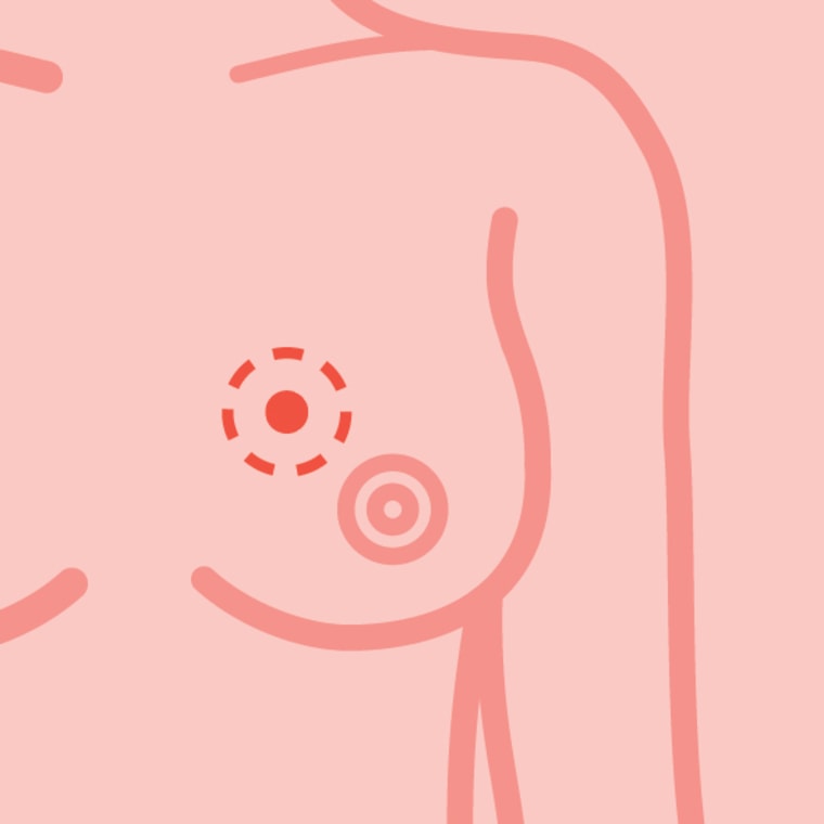 Pictures of Breast Cancer Lumps: How To Identify Warning Signs