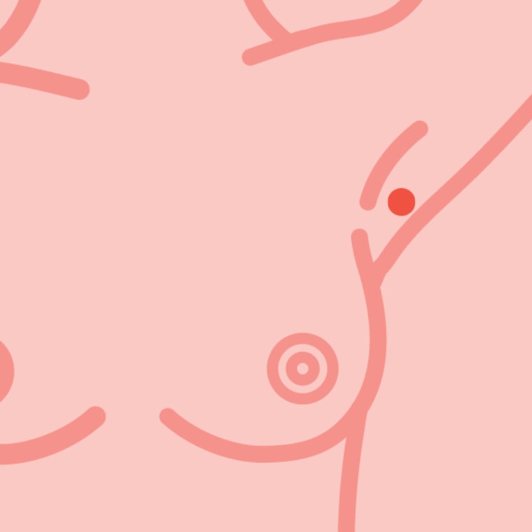 What do cancerous breast lumps feel like?