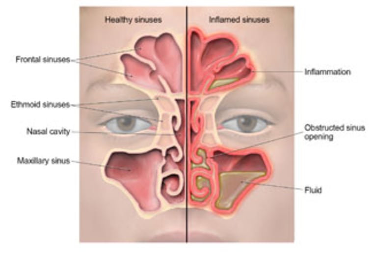 How to deals clear nasal congestion