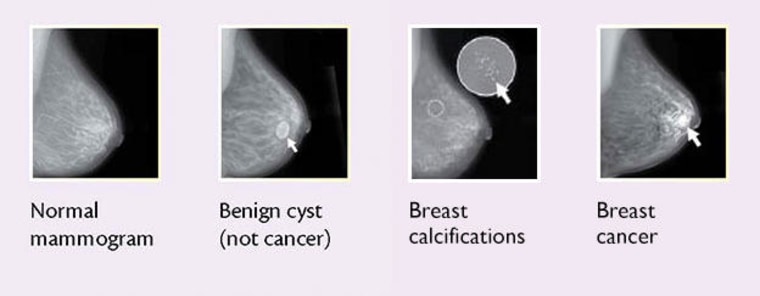 Comparison of the original breast mass images and their flipped images.