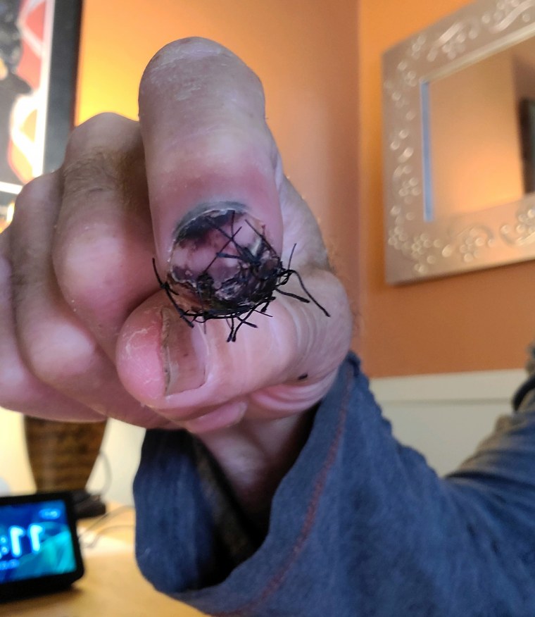 In addition to a traumatic brain injury, Brian Murphy broke his left index finger that required some serious stitches to help it heal.
