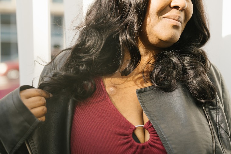 Rhonda Terrell pulls back her hair to show the port where she receives chemotherapy.