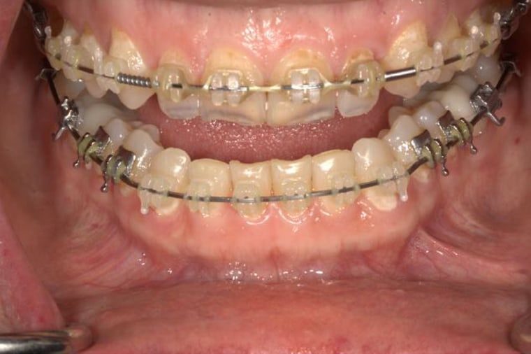 A view of teeth with cavities related to vaping.