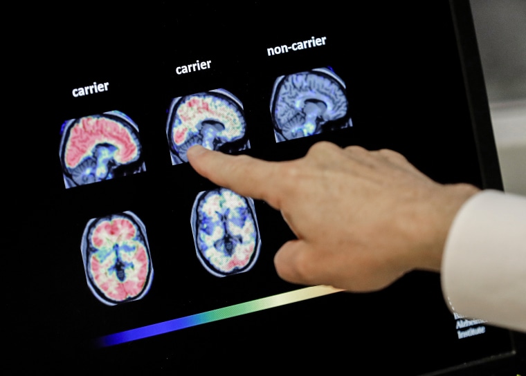 A doctor looks at PET brain scans in Phoenix on Aug. 14, 2018.