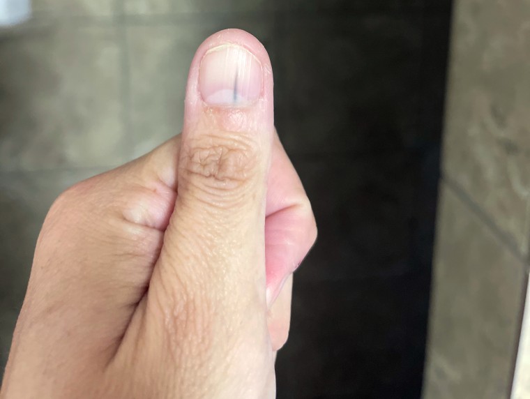After meeting with the dermatologist, Charmaine Sherlock began taking photos of the black line on her thumbnail. That helped her to realize it was growing quickly, which she worried was a sign that it was a skin cancer.
