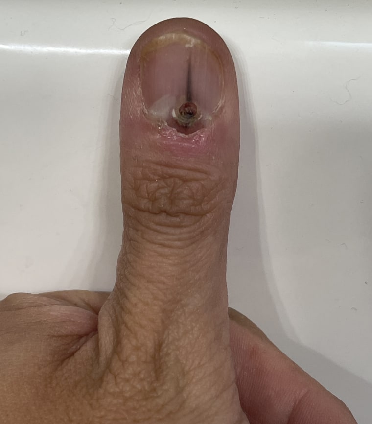 To understand if a person has cancer under their nail, doctors do a biopsy into the nail bed. Charmaine Sherlock found it incredibly painful the first time. The second biopsy wasn't as bad thanks to a nerve block.