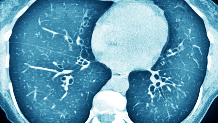 Resonancia magnética de pulmones afectados por fibrosis quística