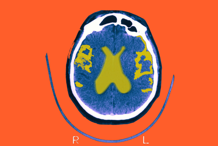 Scan of the brain of a patient affected by Alzheimer's.