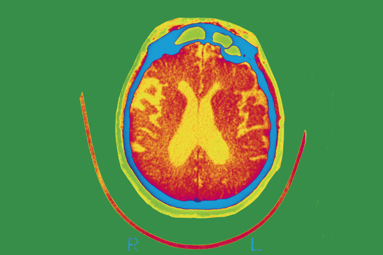 Escáner cerebral de un paciente con alzhéimer.