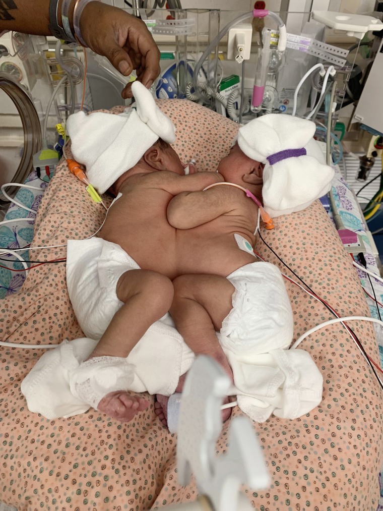 Only one in roughly 200,000 live births results in conjoined twins.
