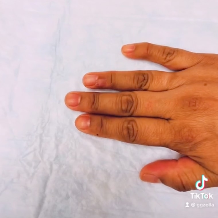 Cancer on a finger