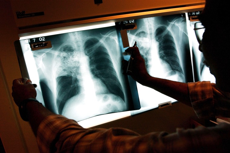 A doctor examines the x-rays of a tuberculosis (TB) patient at a TB clinic Novmeber 27, 2002 in Brooklyn, New York.