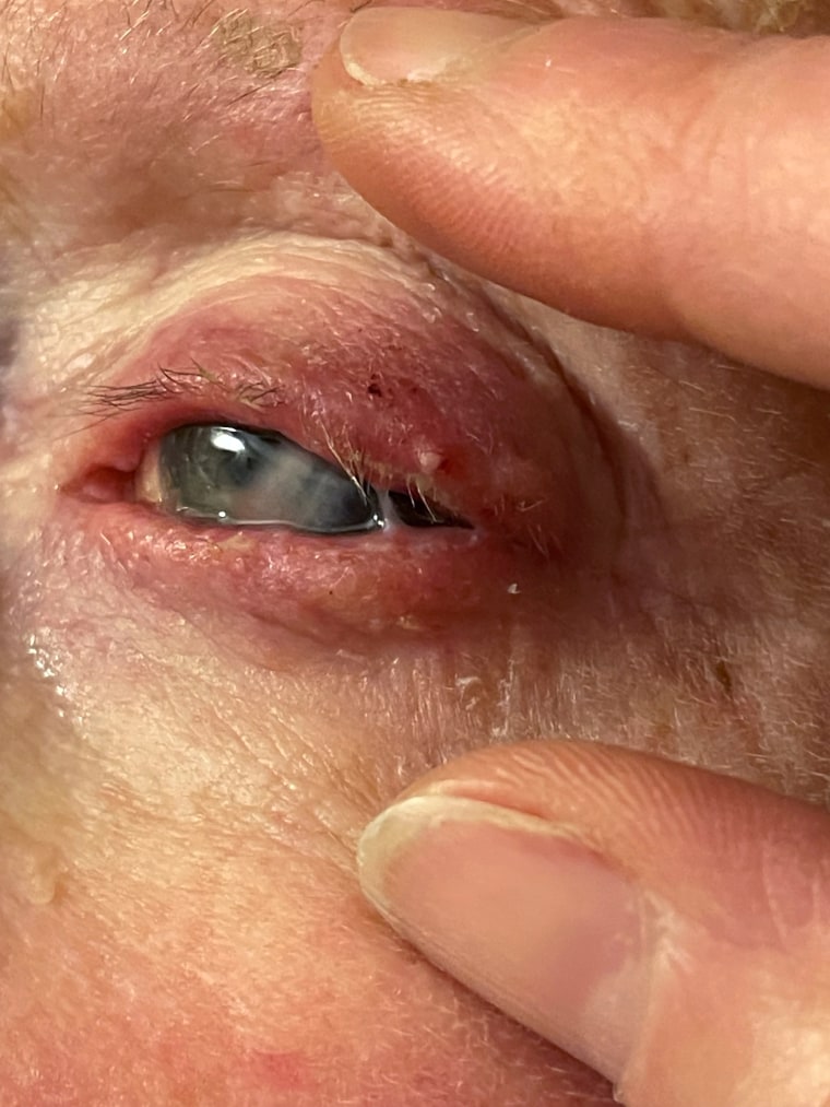 This photo of Judy Gregory's eye was taken in January, eight months after she was initially infected.