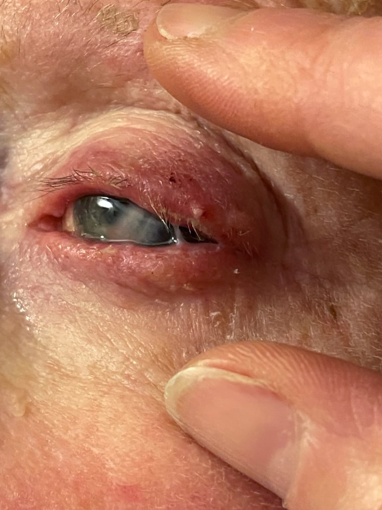 An infected eye.