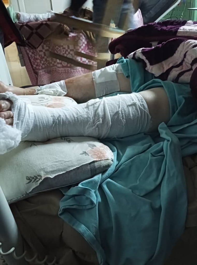 A photo of Ibrahim Zakaria's mother's injuries. She suffers from two broken legs and severe wounds on her back after spending five days trapped under the rubble of a 5-story building.