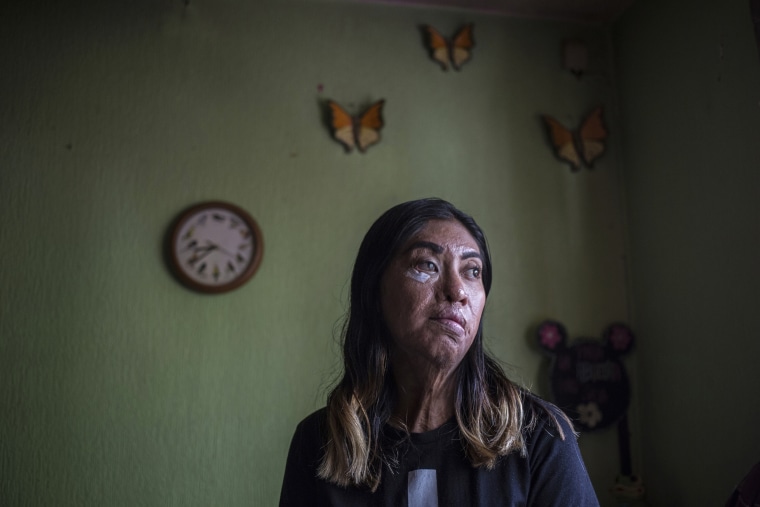 Esmeralda Millan, who survived an acid attack by her ex-partner, in Puebla, Mexico