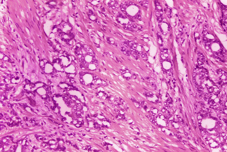This microscope image from 1974, provided by the Centers for Disease Control and Prevention, shows changes in cells indicative of adenocarcinoma of the prostate.