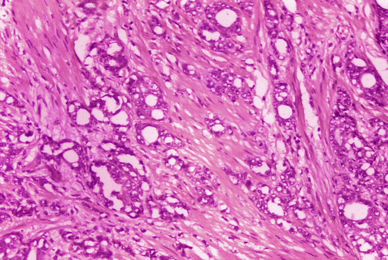 Esta imagem de microscópio de 1974 disponibilizada pelos Centros de Controle e Prevenção de Doenças mostra alterações nas células indicativas de adenocarcinoma da próstata.