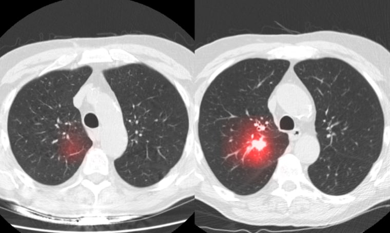 Sybil is able to detect early signs of lung cancer. These CT scans, from the same patient, were taken two years apart. In the scan on the left, the area highlighted in red is what Sybil detected. The scan on the right shows what the radiologists saw two years later. 