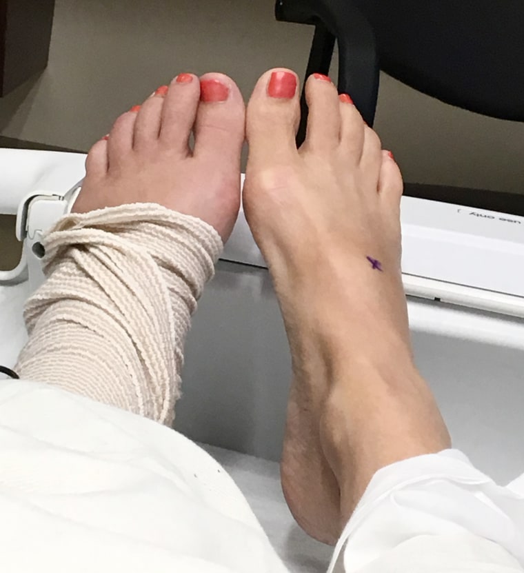 Sarah Lemire todavía tenía una leve rojez del pie izquierdo después de comenzar el tratamiento, como se ve aquí.