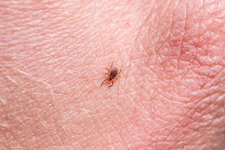A deer tick or black-legged tick (Ixodes scapularis) crawling on skin.