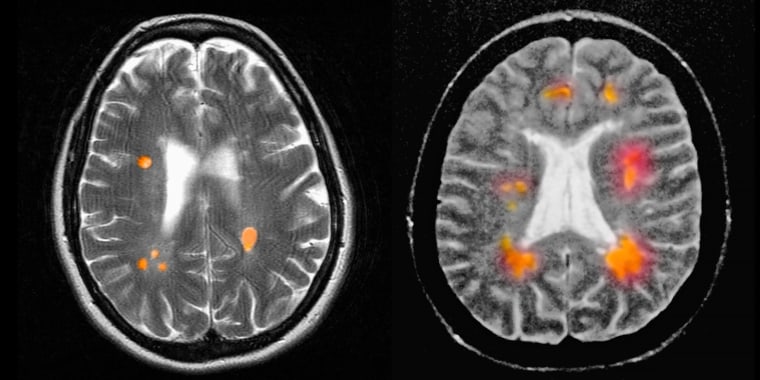 MRI showing multiple sclerosis.