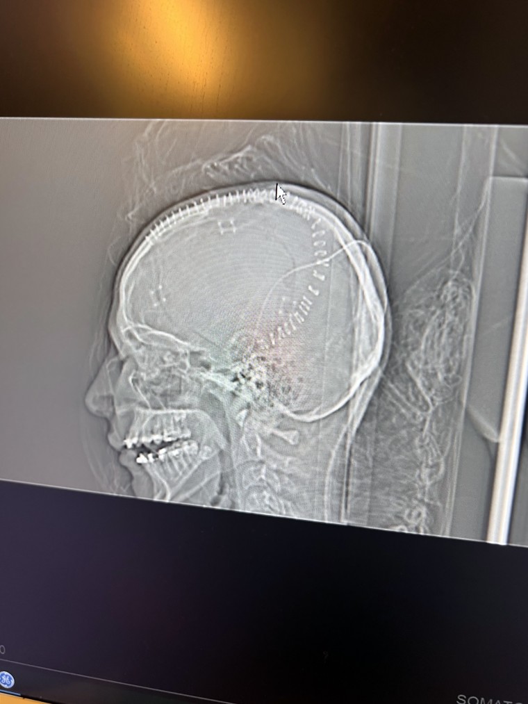 An X-ray shows the staples doctors used to close Caiden Wilson's skull after surgery. Caiden later used the staples to make a cross necklace.