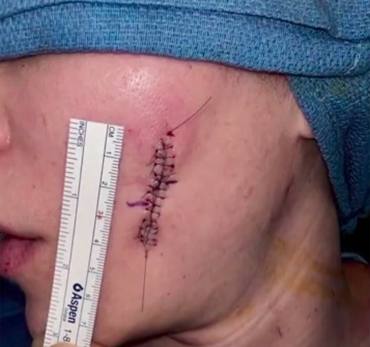 Massakre synder fiktion Khloe Kardashian Shows Stitches From Skin Cancer Surgery In New Trailer