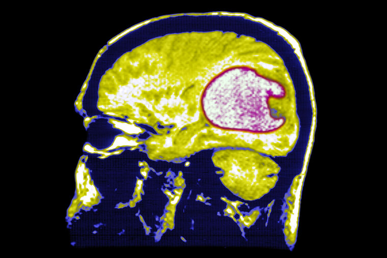 A brain scan showing a glioblastoma.