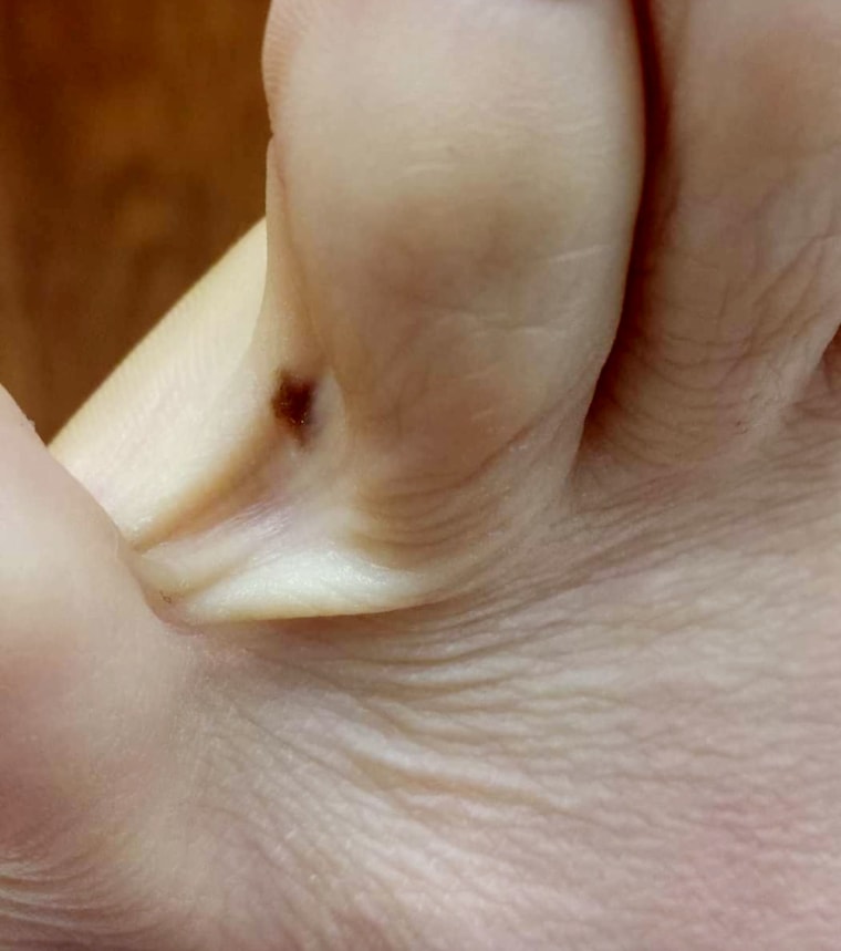 Amy Jardon, between toe melanoma