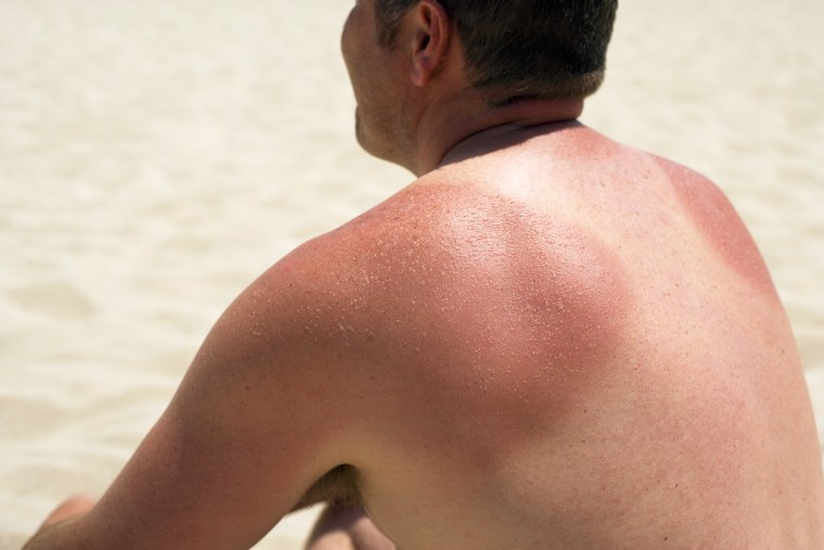Man with sun burnt shoulders sitting on beach.